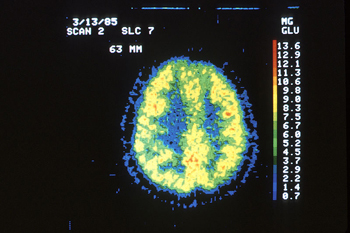 PET scan of a normal brain.